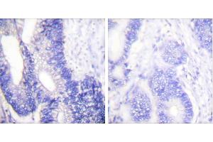 Peptide - +Immunohistochemical analysis of paraffin-embedded human colon carcinoma tissue using Claudin 3 antibody. (Claudin 3 antibody)