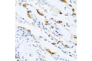 Immunohistochemistry of paraffin-embedded human lung cancer using SFTPC antibody. (Surfactant Protein C antibody)