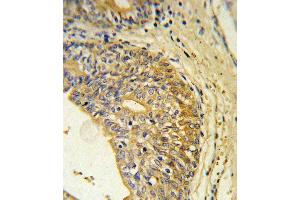 EDNRB Antibody (C-term) (ABIN390760 and ABIN2841017) immunohistochemistry analysis in formalin fixed and paraffin embedded human prostate carcinoma followed by peroxidase conjugation of the secondary antibody and DAB staining. (EDNRB antibody  (C-Term))