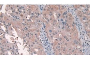 Detection of PCI in Human Breast cancer Tissue using Polyclonal Antibody to Protein C Inhibitor (PCI) (SERPINA5 antibody  (AA 43-406))