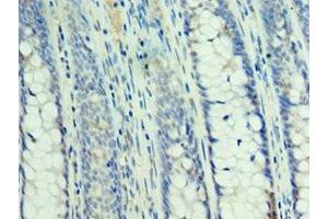 Immunohistochemistry of paraffin-embedded human colon cancer using ABIN7160232 at dilution of 1:100 (SMAD3 antibody  (AA 1-230))