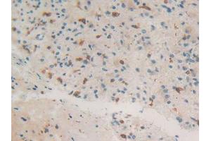 IHC-P analysis of Human Glioma Tissue, with DAB staining. (Coronin 1a antibody  (AA 7-204))