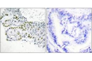 Immunohistochemistry analysis of paraffin-embedded human lung carcinoma, using PKC delta (Phospho-Tyr52) Antibody. (PKC delta antibody  (pTyr52))