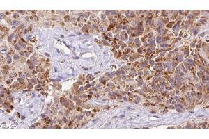 ABIN6273147 at 1/100 staining Human Melanoma tissue by IHC-P. (Osteocalcin antibody  (Internal Region))