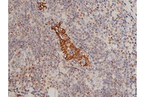ABIN6255334 and ABIN6267311 at 1/200 staining human breast cancer tissue sections by IHC-P. (KRT8 antibody  (pSer432))