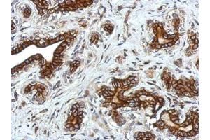 IHC-P Image Immunohistochemical analysis of paraffin-embedded human breast cancer, using Glycine Receptor alpha 2, antibody at 1:750 dilution. (GLRa2 antibody)