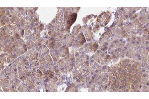 ABIN6273276 at 1/100 staining Human pancreas cancer tissue by IHC-P. (NSDHL antibody  (Internal Region))