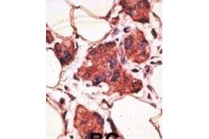 Formalin-fixed and paraffin-embedded human cancer tissue reacted with the primary antibody, which was peroxidase-conjugated to the secondary antibody, followed by AEC staining. (MAGEA9 antibody  (AA 171-198))