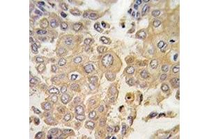 IHC analysis of FFPE human lung carcinoma tissue stained with MAPK4 antibody (MAPK4 antibody  (AA 72-101))