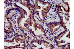 IHC image of ABIN7165980 diluted at 1:400 and staining in paraffin-embedded human lung cancer performed on a Leica BondTM system. (SSH3 antibody  (AA 480-659))