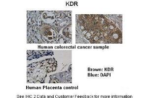 Researcher: Department of Pathology, Hospital de Carabineros de Chile, Santiago, ChileApplication: IHCSpecies+tissue/cell type: Control-Human Placenta, Sample-Human colorectal cancer Primary Antibody dilution: 1:100Secondary Antibody: Biotinylated pig anti-rabbit+streptavidin-HRP (VEGFR2/CD309 antibody  (N-Term))