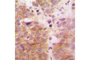 Immunohistochemical analysis of TAK1 staining in human breast cancer formalin fixed paraffin embedded tissue section. (TR4 antibody  (Center))