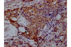 IHC image of ABIN7127867 diluted at 1:100 and staining in paraffin-embedded human breast cancer performed on a Leica BondTM system. (Recombinant VCP antibody)