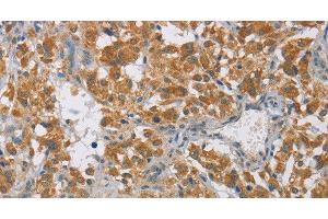 Immunohistochemistry of paraffin-embedded Human thyroid cancer tissue using DIO1 Polyclonal Antibody at dilution 1:60 (DIO1 antibody)
