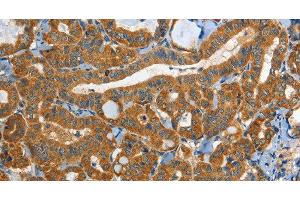 Immunohistochemistry of paraffin-embedded Human thyroid cancer tissue using EPHB3 Polyclonal Antibody at dilution 1:40 (EPH Receptor B3 antibody)