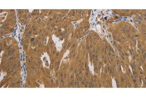 Immunohistochemistry of paraffin-embedded Human ovarian cancer using NIT2 Polyclonal Antibody at dilution of 1:40 (NIT2 antibody)