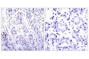 Immunohistochemical analysis of paraffin-embedded human breast carcinoma tissue using STAT3 (Ab-727) antibody (E021046). (STAT3 antibody)
