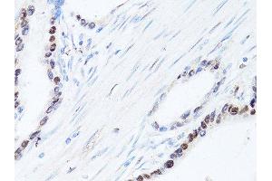 Immunohistochemistry of paraffin-embedded human colon carcinoma using SQSTM1 antibody.