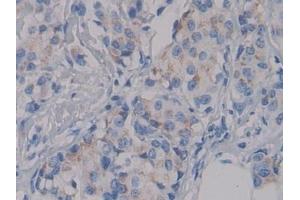 Detection of NPHN in Human Breast cancer Tissue using Polyclonal Antibody to Nephrin (NPHN) (Nephrin antibody  (AA 23-92))