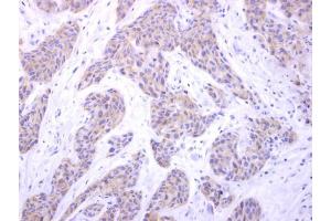 IHC-P Image PIGK antibody [N1C2] detects PIGK protein at cytosol on human breast carcinoma by immunohistochemical analysis. (PIGK antibody)