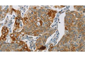 Immunohistochemistry of paraffin-embedded Human cervical cancer using SMOC2 Polyclonal Antibody at dilution of 1:30 (SMOC2 antibody)