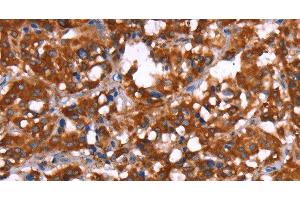 Immunohistochemistry of paraffin-embedded Human thyroid cancer tissue using GAGE12I Polyclonal Antibody at dilution 1:30 (G Antigen 12I antibody)