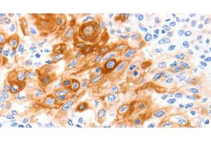 Immunohistochemistry of paraffin-embedded Human cervical cancer tissue using SLC2A11 Polyclonal Antibody at dilution 1:140 (SLC2A11 antibody)