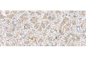 Immunohistochemistry of paraffin-embedded Human liver cancer tissue using NDRG4 Polyclonal Antibody at dilution of 1:45(x200) (NDRG4 antibody)