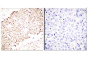 Immunohistochemistry analysis of paraffin-embedded human breast carcinoma tissue using SENP1 antibody. (SENP1 antibody  (N-Term))