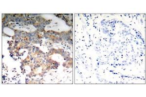 Immunohistochemical analysis of paraffin-embedded human breast carcinoma tissue using IkB-ε (Ab-22) antibody (E021296). (NFKBIE antibody)