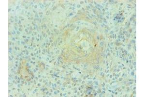 Immunohistochemical of paraffin-embedded human breast cancer using ABIN7168560 at dilution of 1:200 (S1A9 antibody)