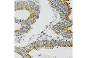 Immunohistochemistry of paraffin-embedded human colon carcinoma using ND5 antibody (ABIN5975833) at dilution of 1/100 (40x lens). (MT-ND5 antibody)