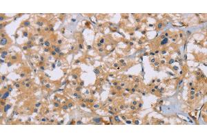 Immunohistochemistry of paraffin-embedded Human thyroid cancer using ACTN4 Polyclonal Antibody at dilution of 1:60 (alpha Actinin 4 antibody)