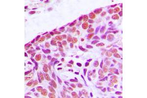Immunohistochemical analysis of MEKK3 staining in human breast cancer formalin fixed paraffin embedded tissue section. (MAP3K3 antibody  (Center))