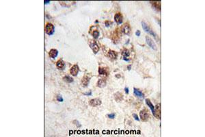 Formalin-fixed and paraffin-embedded human prostate carcinoma tissue reacted with KLF4 polyclonal antibody  , which was peroxidase-conjugated to the secondary antibody, followed by DAB staining. (KLF4 antibody  (N-Term))