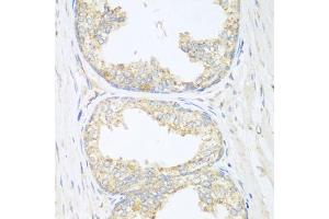 Immunohistochemistry of paraffin-embedded human prostate using SGCB antibody (ABIN5975455) at dilution of 1/100 (40x lens). (SGCB antibody)