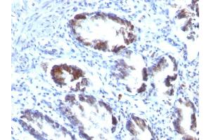 Formalin-fixed, paraffin-embedded human Colon Carcinoma stained with Transgelin Monoclonal Antibody (TAGLN/247) (Transgelin antibody)