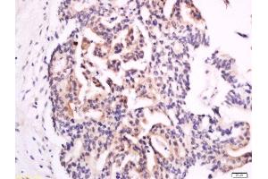 Formalin-fixed and paraffin embedded human colon carcinoma labeled with Anti-XTP4 Polyclonal Antibody, Unconjugated  at 1:300 followed by conjugation to the secondary antibody and DAB staining. (C17orf37 antibody  (AA 10-60))