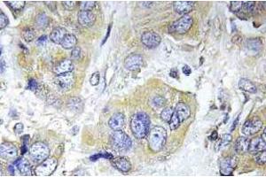 Immunohistochemistry (IHC) analyzes of p-p70 S6 kinase alpha antibody in paraffin-embedded human breast carcinoma tissue. (RPS6KB1 antibody  (pSer434))