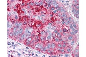 Anti-FZD1 / Frizzled 1 antibody IHC of human Lung, Non-Small Cell Carcinoma. (FZD1 antibody  (N-Term))
