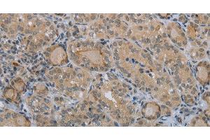 Immunohistochemistry of paraffin-embedded Human thyroid cancer tissue using CLEC1A Polyclonal Antibody at dilution 1:40 (CLEC1A antibody)