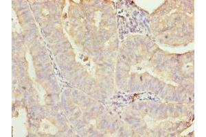 Immunohistochemistry of paraffin-embedded human endometrial cancer using ABIN7160680 at dilution of 1:100 (GALNT7 antibody  (AA 201-500))