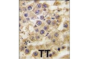 Formalin-fixed and paraffin-embedded human testis tissue reacted with NANOS2 antibody (C-term) (ABIN389197 and ABIN2839360) , which was peroxidase-conjugated to the secondary antibody, followed by DAB staining. (NANOS2 antibody  (C-Term))