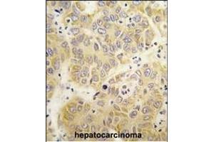 Formalin-fixed and paraffin-embedded human hepatocarcinoma tissue reacted with the VARS antibody (N-term)  , which was peroxidase-conjugated to the secondary antibody, followed by DAB staining. (VARS antibody  (N-Term))