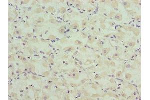 Immunohistochemistry of paraffin-embedded human gastric cancer using ABIN7146581 at dilution of 1:100 (Calsequestrin antibody  (AA 127-396))