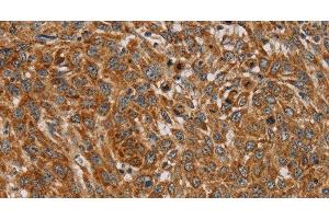 Immunohistochemistry of paraffin-embedded Human lung cancer using PLEKHG6 Polyclonal Antibody at dilution of 1:45