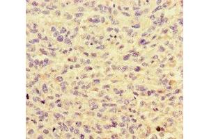 Immunohistochemistry of paraffin-embedded human melanoma using ABIN7155108 at dilution of 1:100 (HNRNPF antibody  (AA 186-336))