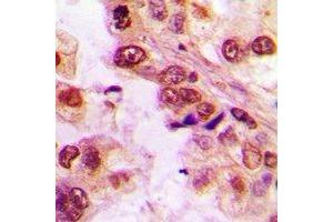 Immunohistochemical analysis of ASC-1 staining in human lung cancer formalin fixed paraffin embedded tissue section. (TRIP4 antibody)