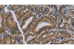 Immunohistochemistry of paraffin-embedded Human thyroid cancer using NAT10 Polyclonal Antibody at dilution of 1:40 (NAT10 antibody)
