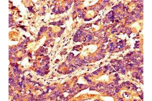 Immunohistochemistry of paraffin-embedded human colon cancer using ABIN7155305 at dilution of 1:100 (HDAC1 antibody  (AA 207-412))